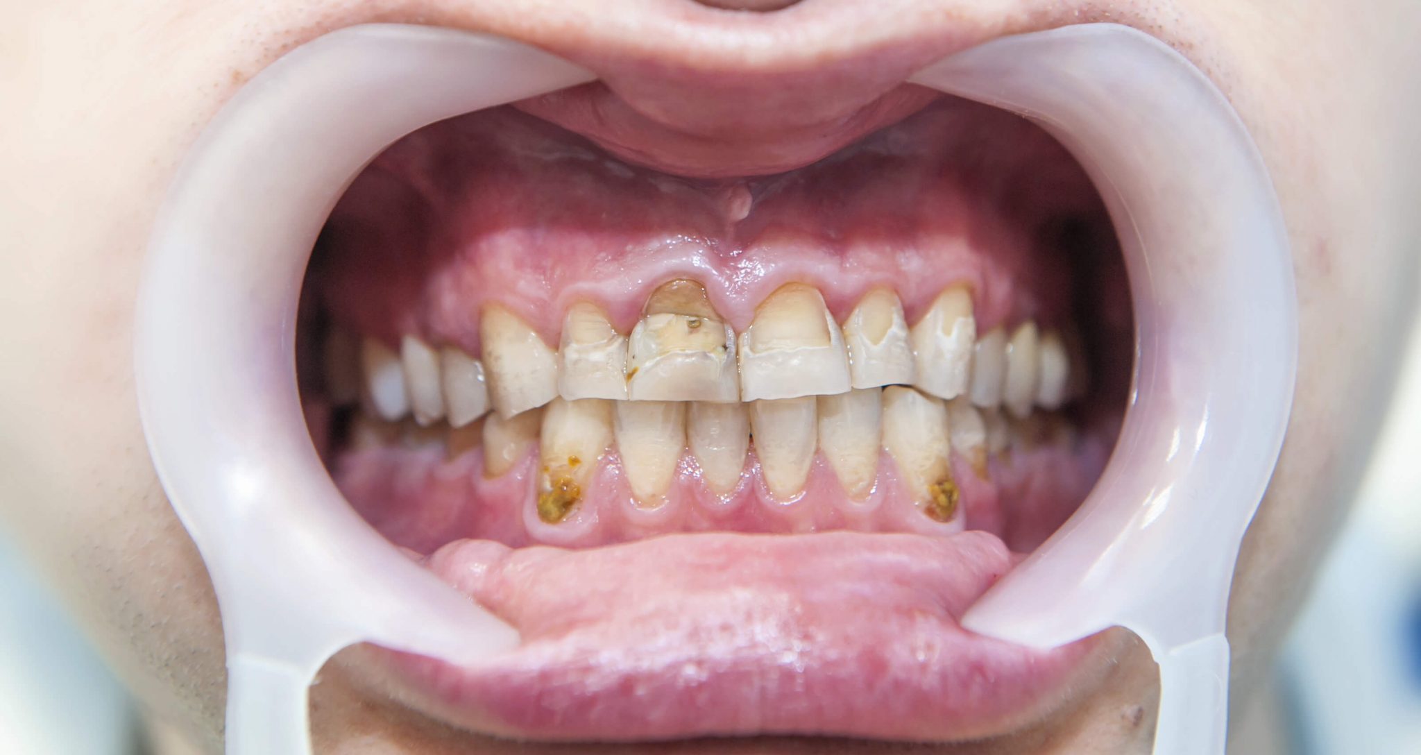 Dental Fluoride Treatment Side Effects